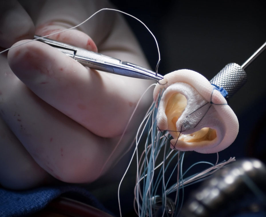 Mitral Valve Repair